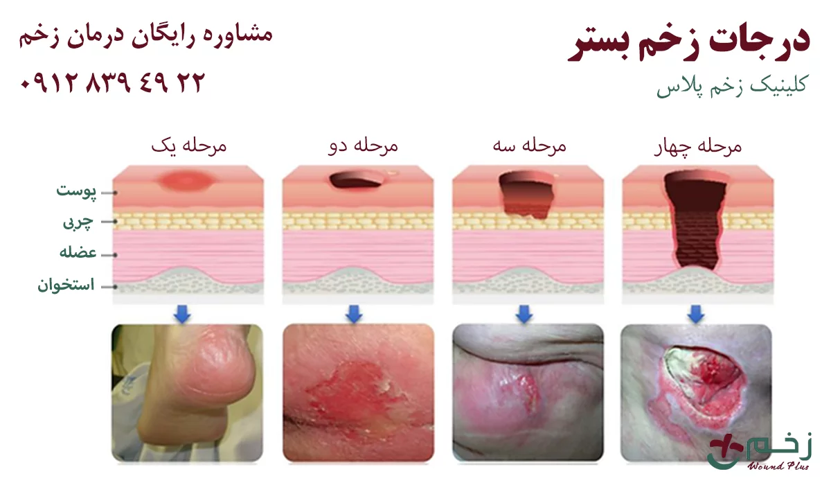 درجات زخم بستر