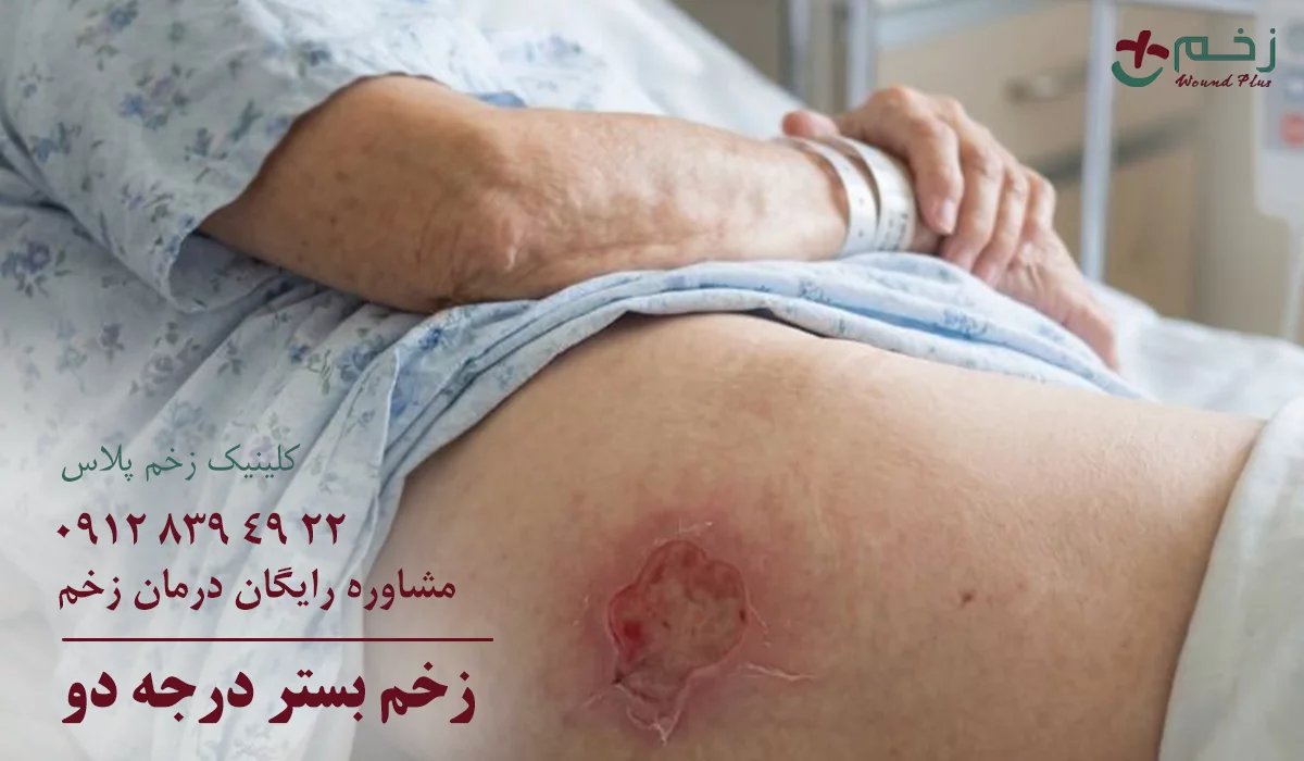 زخم بستر درجه دو