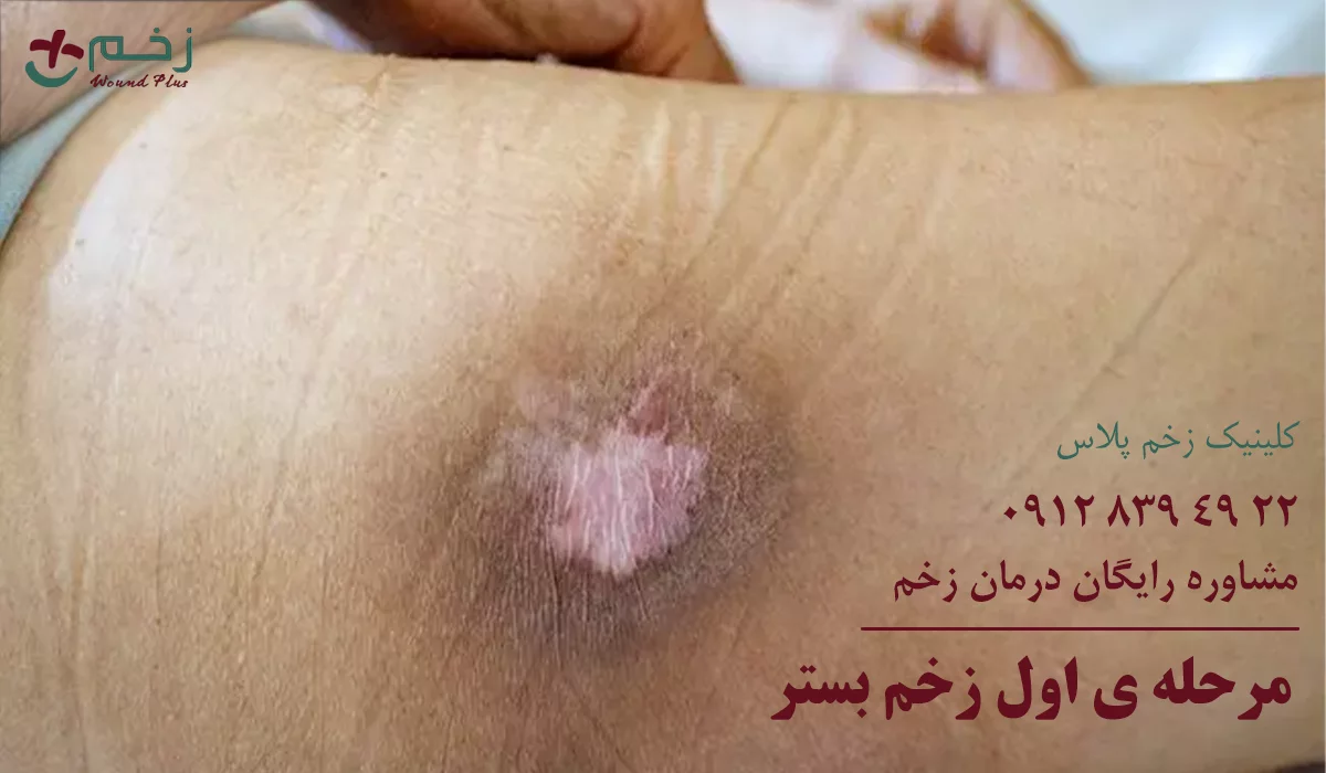 مرحله اول زخم بستر